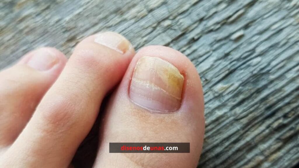 Cuáles son los problemas de las uñas de los pies