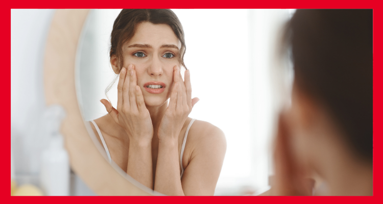 Qué causa el acné en adultos y cómo deshacerse de él
