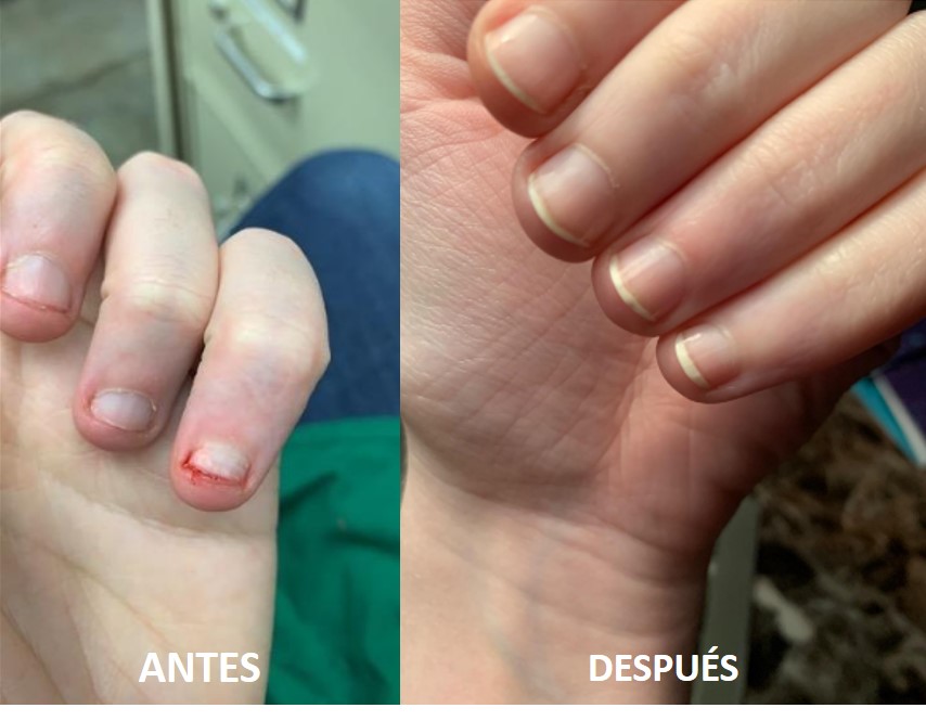 Opinión de antes y después de los resultados del Aceite de uñas y cutículas OPI