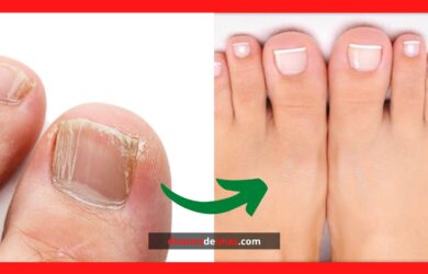 consejos para deshacerse de los Hongos en las uñas de los pies
